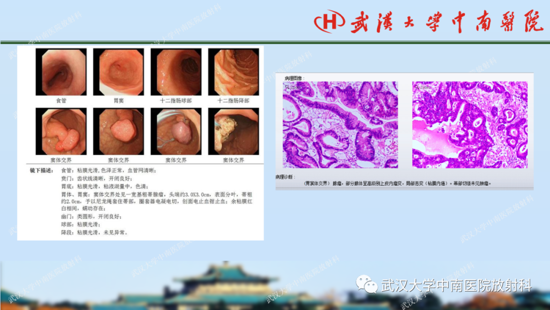 影像PPT - 【PPT】胃占位病变影像诊断分析-51