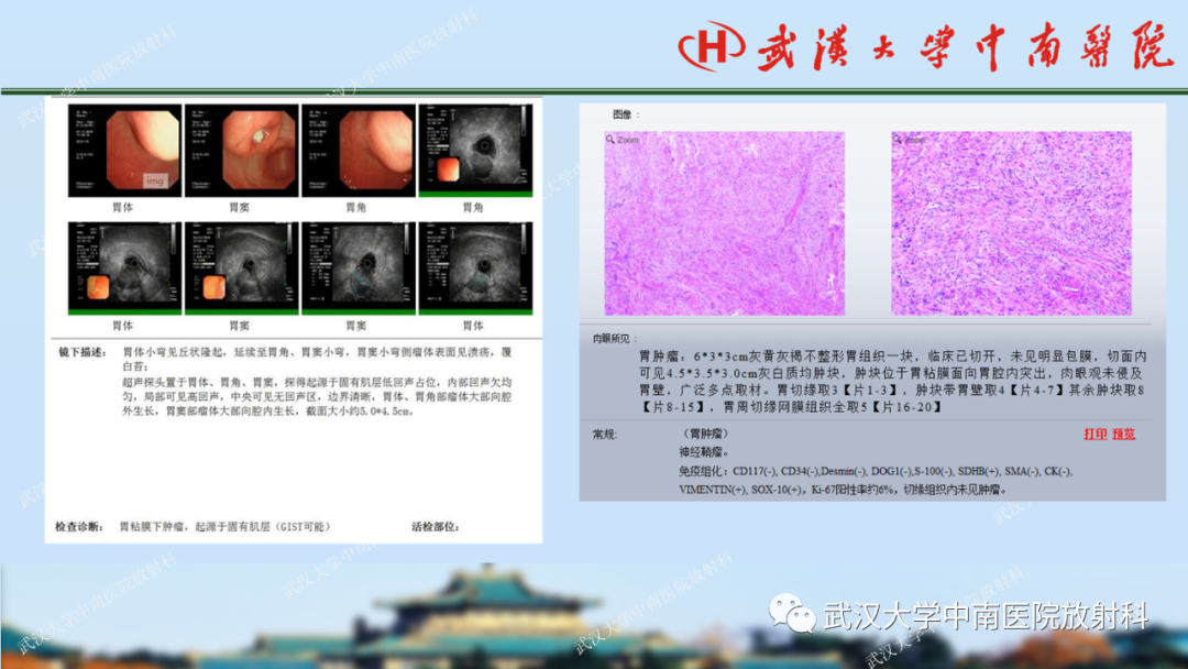 影像PPT - 【PPT】胃占位病变影像诊断分析-55