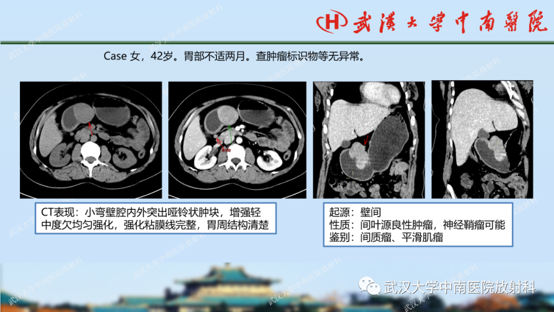 影像PPT - 【PPT】胃占位病变影像诊断分析-54