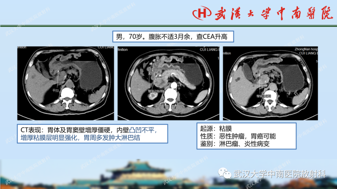 影像PPT - 【PPT】胃占位病变影像诊断分析-58