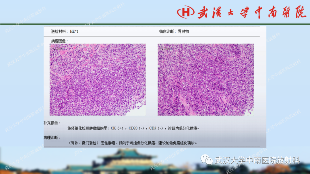 影像PPT - 【PPT】胃占位病变影像诊断分析-59