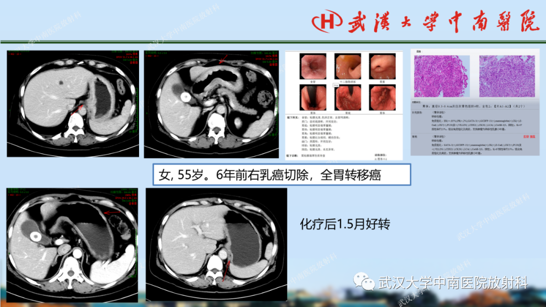 影像PPT - 【PPT】胃占位病变影像诊断分析-61