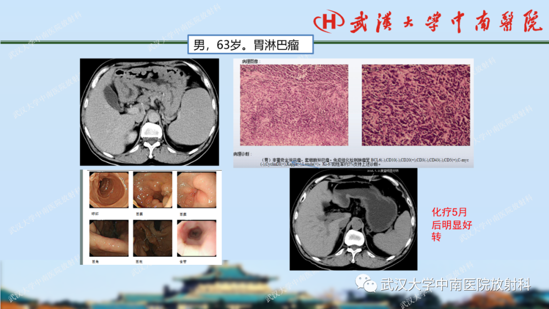 影像PPT - 【PPT】胃占位病变影像诊断分析-60