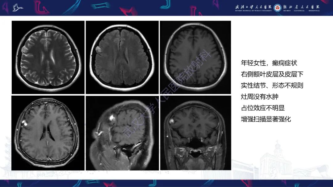 影像PPT - 【PPT】脑多形性黄色星形细胞瘤影像诊断-6