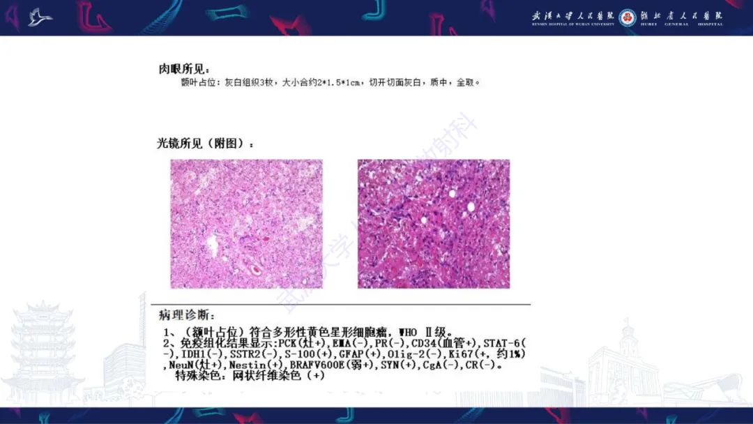 影像PPT - 【PPT】脑多形性黄色星形细胞瘤影像诊断-8