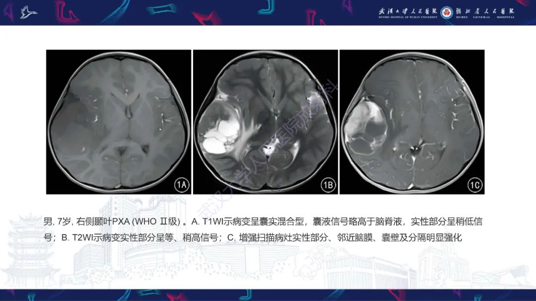 影像PPT - 【PPT】脑多形性黄色星形细胞瘤影像诊断-16