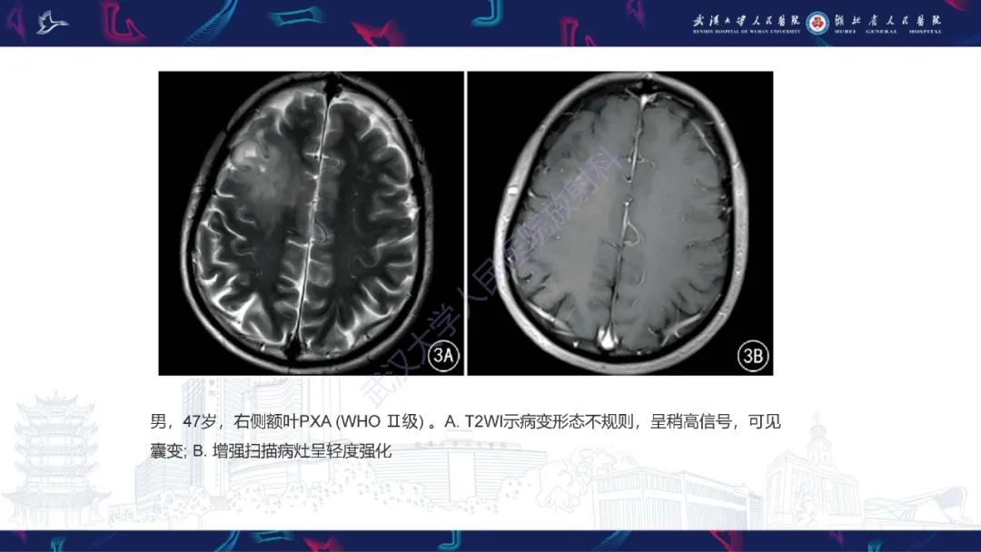 影像PPT - 【PPT】脑多形性黄色星形细胞瘤影像诊断-17