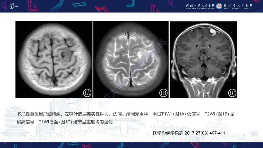 影像PPT - 【PPT】脑多形性黄色星形细胞瘤影像诊断-18