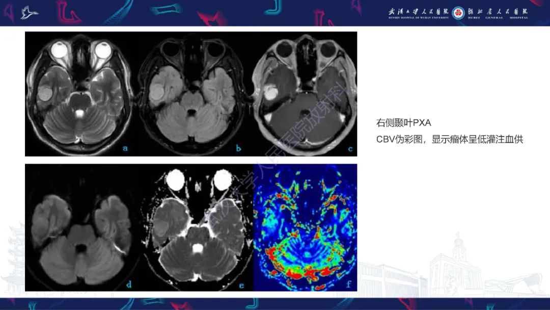 影像PPT - 【PPT】脑多形性黄色星形细胞瘤影像诊断-19