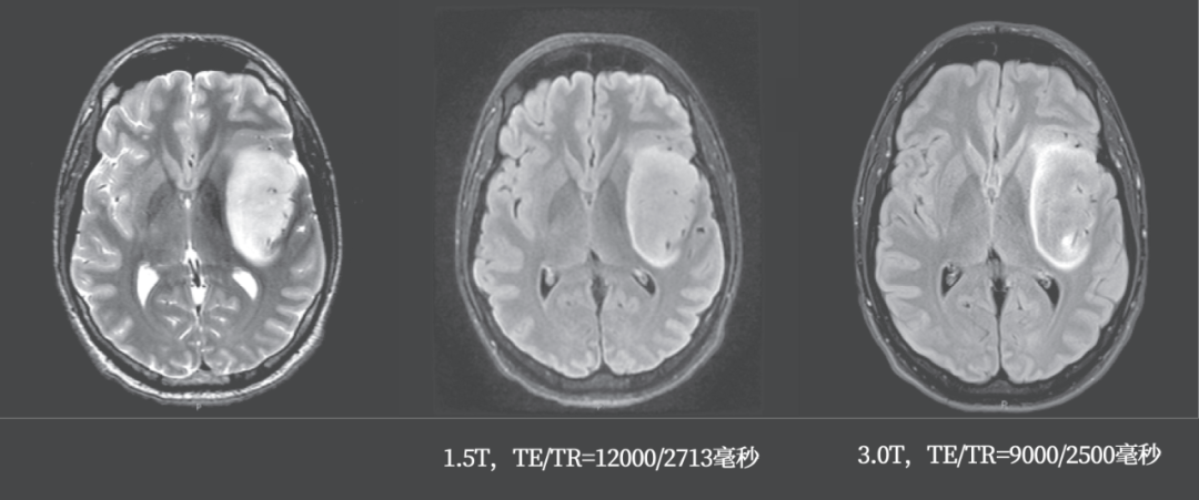 影像PPT - T2-FLAIR 错配征——这个影像征象很特异-11