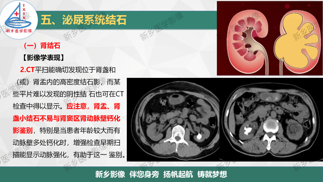 影像PPT - 【PPT】泌尿系结石的影像表现及诊断注意事项-7