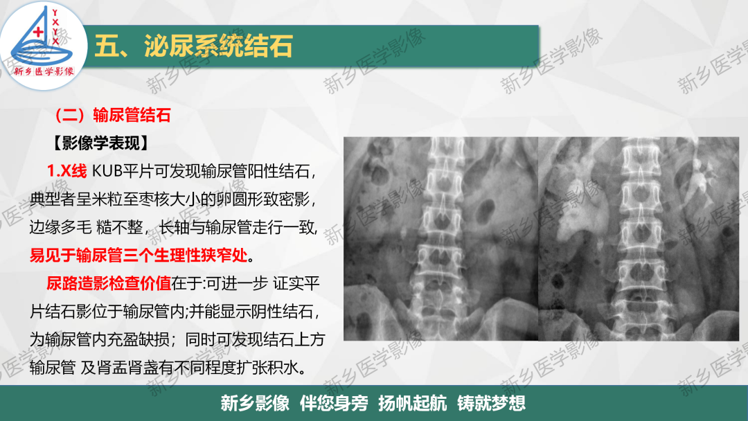 影像PPT - 【PPT】泌尿系结石的影像表现及诊断注意事项-10