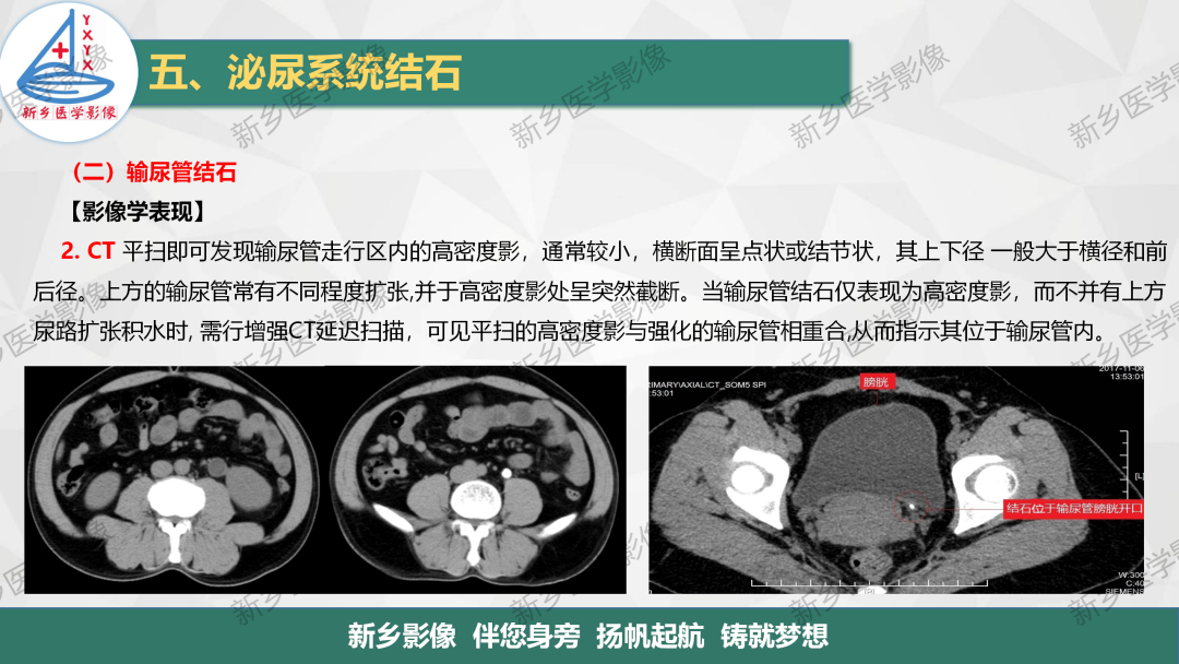 影像PPT - 【PPT】泌尿系结石的影像表现及诊断注意事项-11