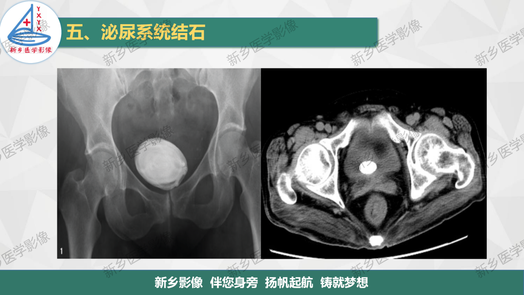 影像PPT - 【PPT】泌尿系结石的影像表现及诊断注意事项-14