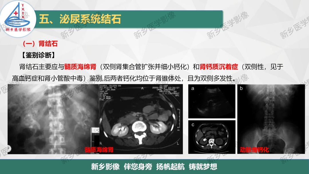 影像PPT - 【PPT】泌尿系结石的影像表现及诊断注意事项-8
