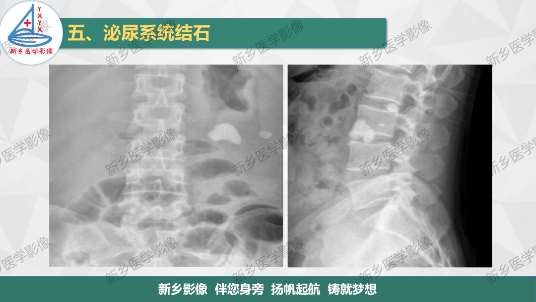 影像PPT - 【PPT】泌尿系结石的影像表现及诊断注意事项-3