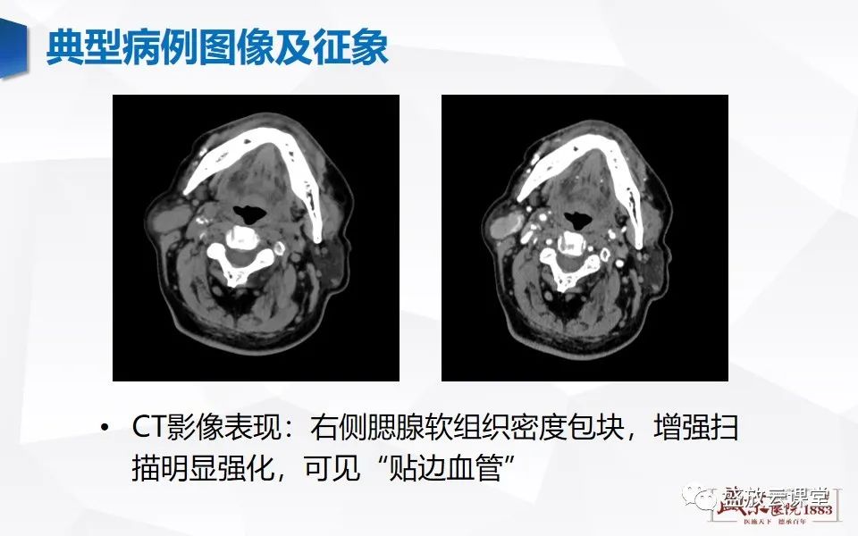 影像PPT - 【病例】腮腺肿瘤—腮腺腺淋巴瘤1例CT及MR-4