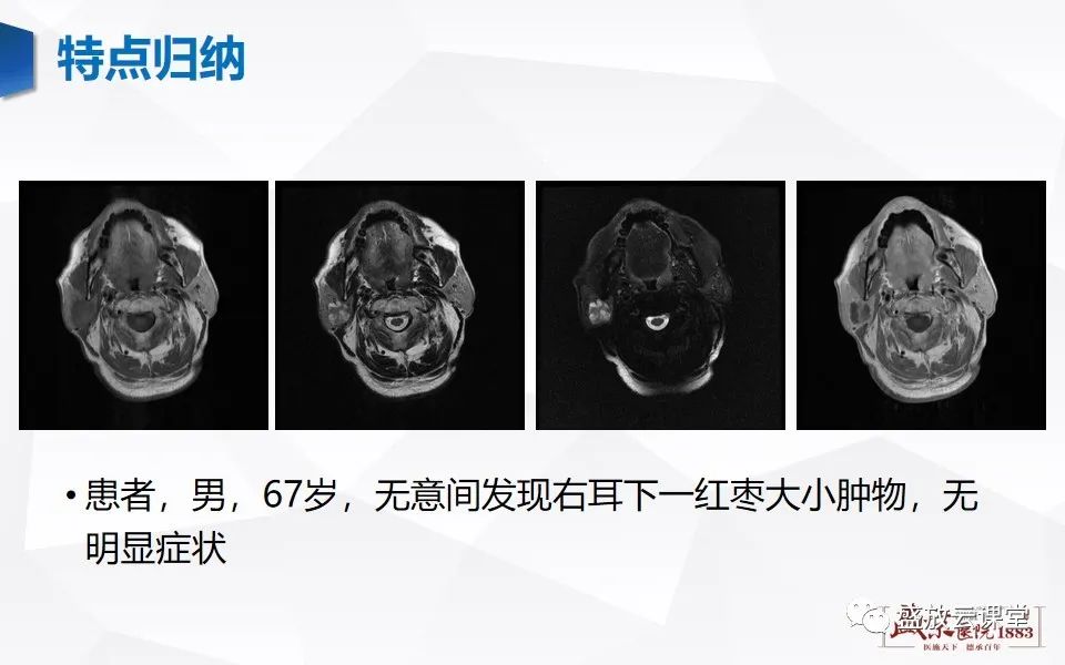 影像PPT - 【病例】腮腺肿瘤—腮腺腺淋巴瘤1例CT及MR-11
