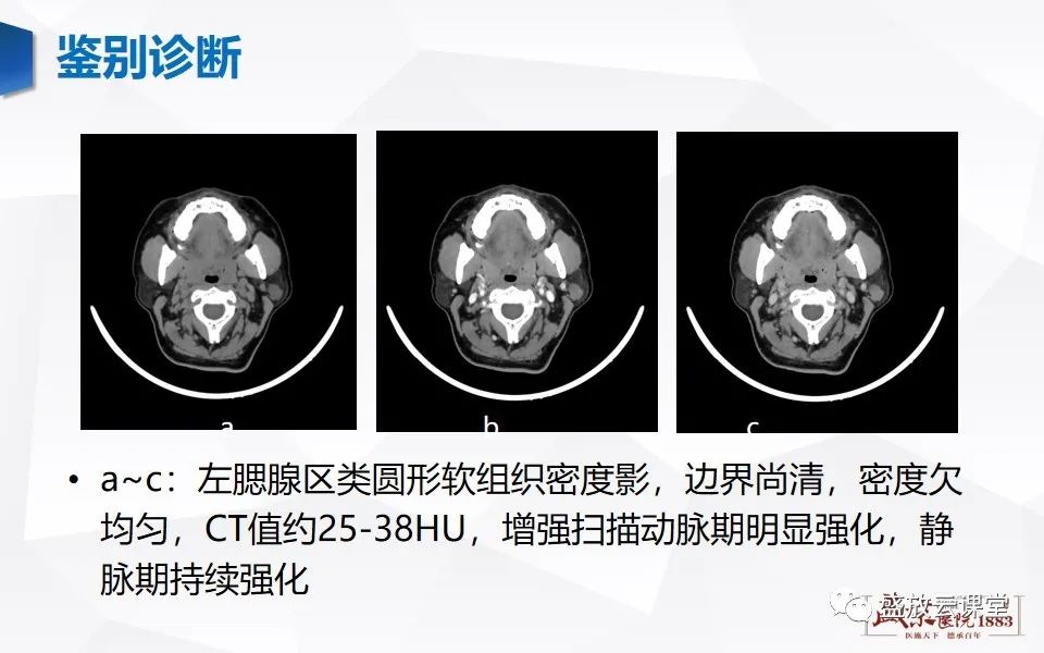 影像PPT - 【病例】腮腺肿瘤—腮腺腺淋巴瘤1例CT及MR-15