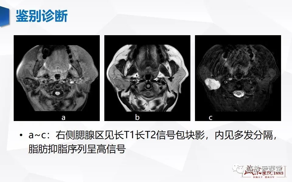 影像PPT - 【病例】腮腺肿瘤—腮腺腺淋巴瘤1例CT及MR-17