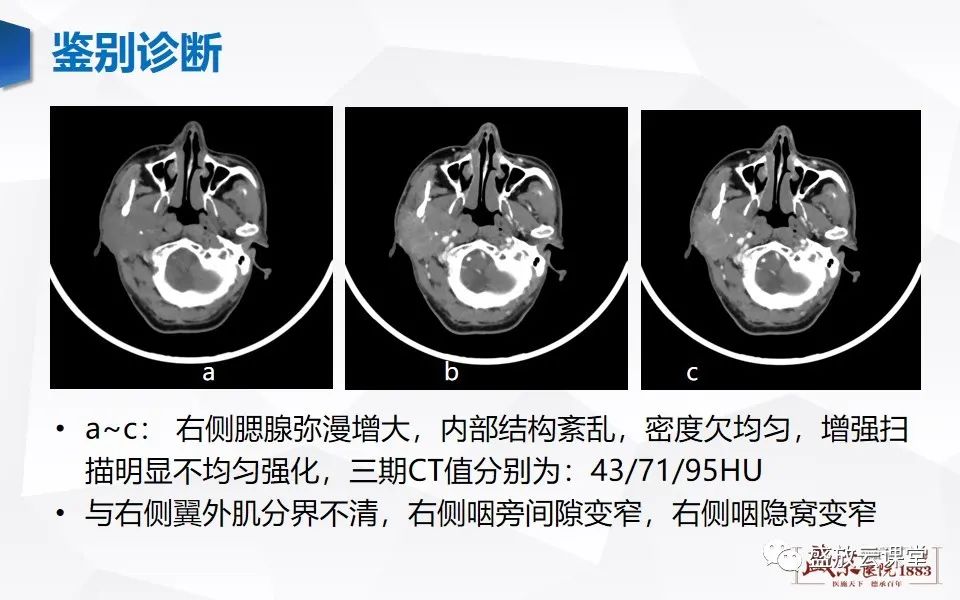 影像PPT - 【病例】腮腺肿瘤—腮腺腺淋巴瘤1例CT及MR-20