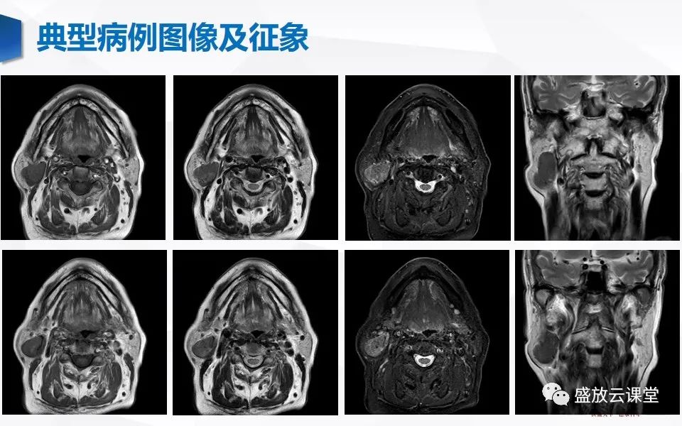 影像PPT - 【病例】腮腺肿瘤—腮腺腺淋巴瘤1例CT及MR-2