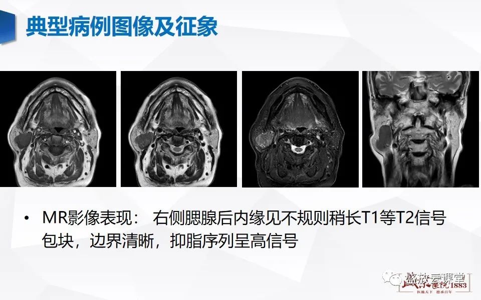 影像PPT - 【病例】腮腺肿瘤—腮腺腺淋巴瘤1例CT及MR-1