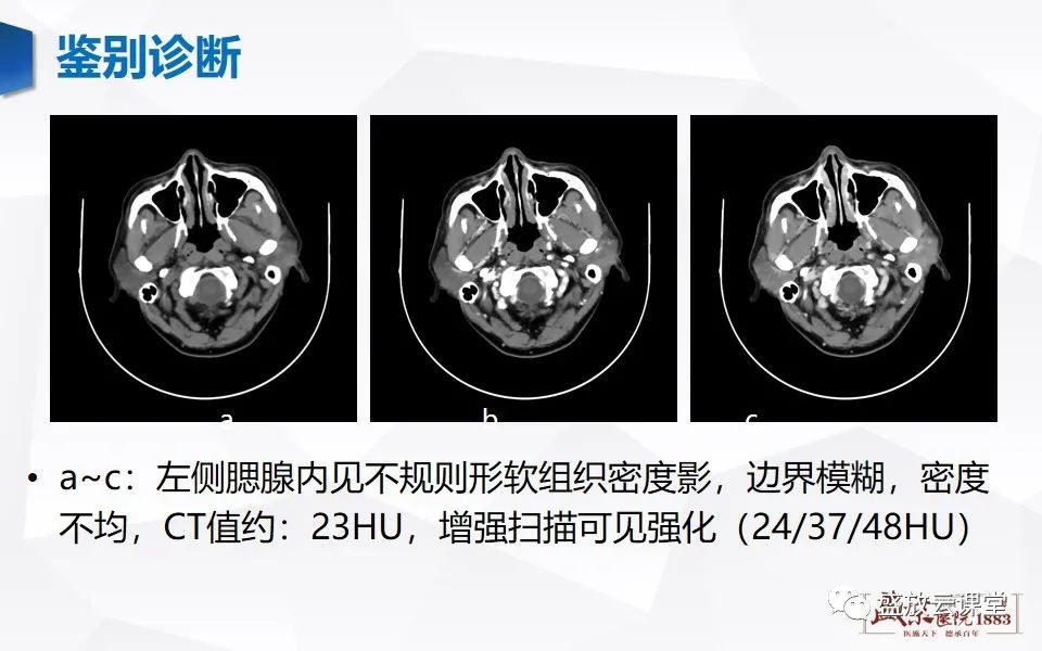 影像PPT - 【病例】腮腺肿瘤—腮腺腺淋巴瘤1例CT及MR-2