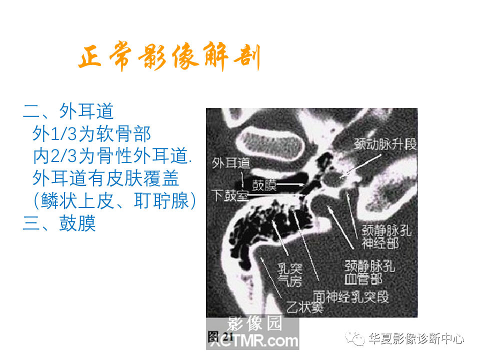 影像PPT - 【PPT】耳的影像解剖及常见疾病诊断-5