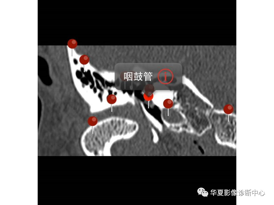 影像PPT - 【PPT】耳的影像解剖及常见疾病诊断-7