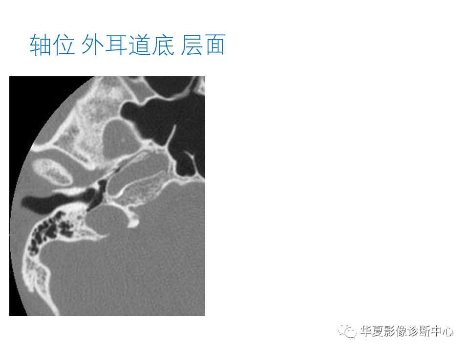 影像PPT - 【PPT】耳的影像解剖及常见疾病诊断-14