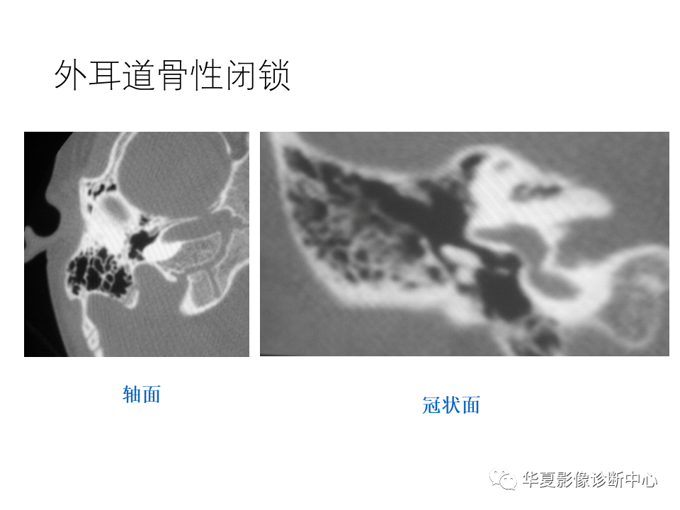 影像PPT - 【PPT】耳的影像解剖及常见疾病诊断-18