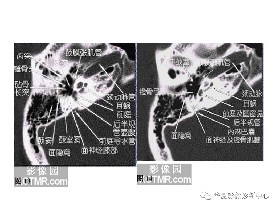 影像PPT - 【PPT】耳的影像解剖及常见疾病诊断-23