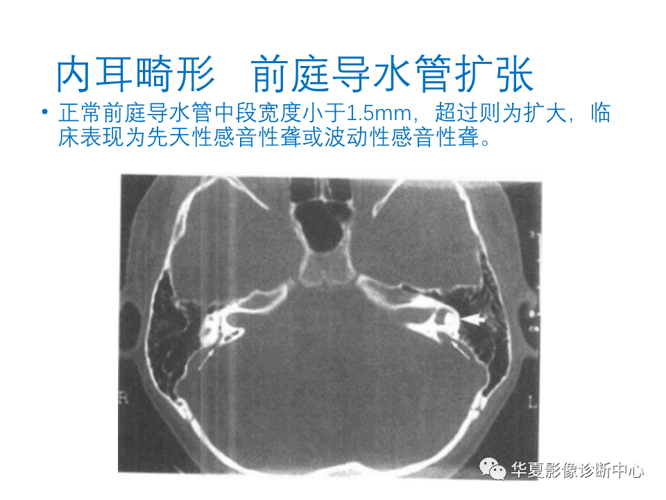 影像PPT - 【PPT】耳的影像解剖及常见疾病诊断-22