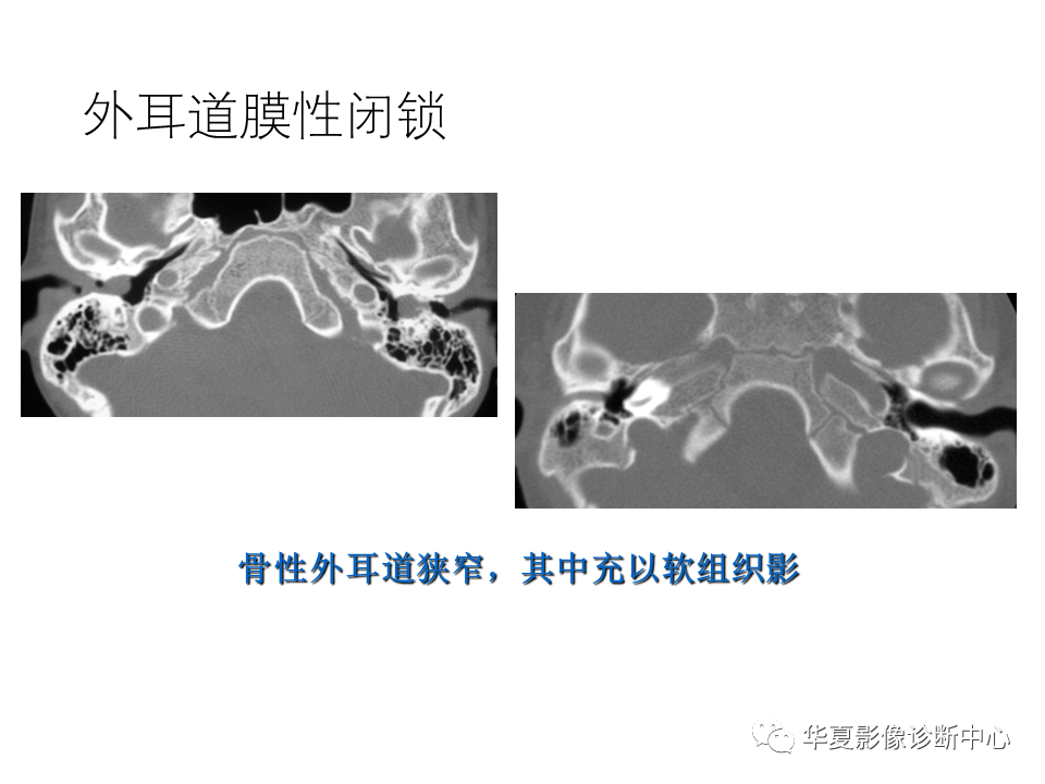 影像PPT - 【PPT】耳的影像解剖及常见疾病诊断-19