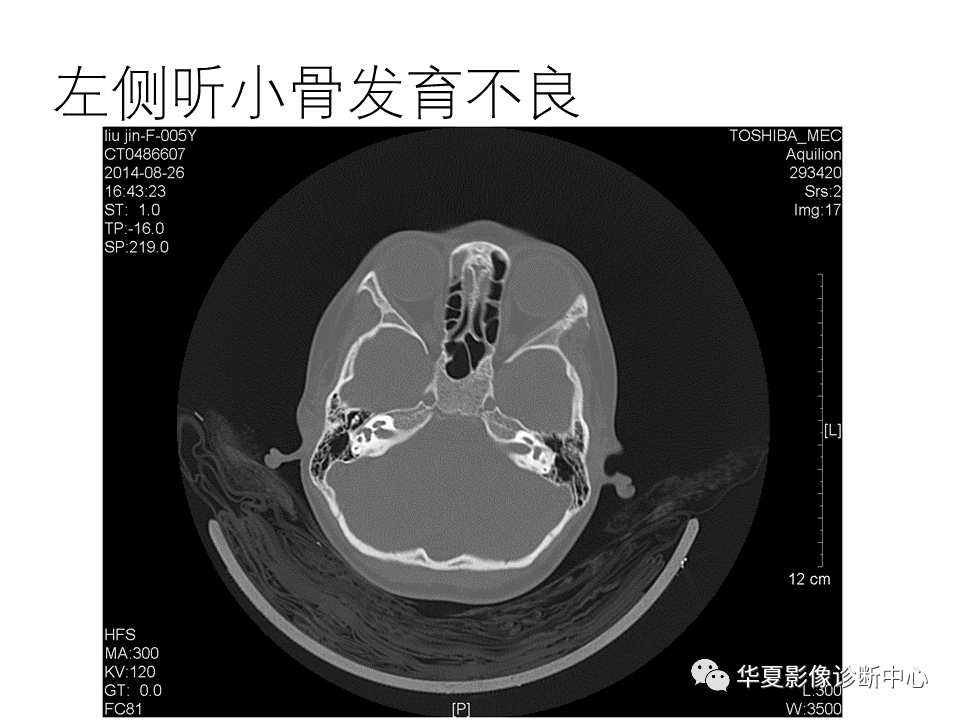 影像PPT - 【PPT】耳的影像解剖及常见疾病诊断-21