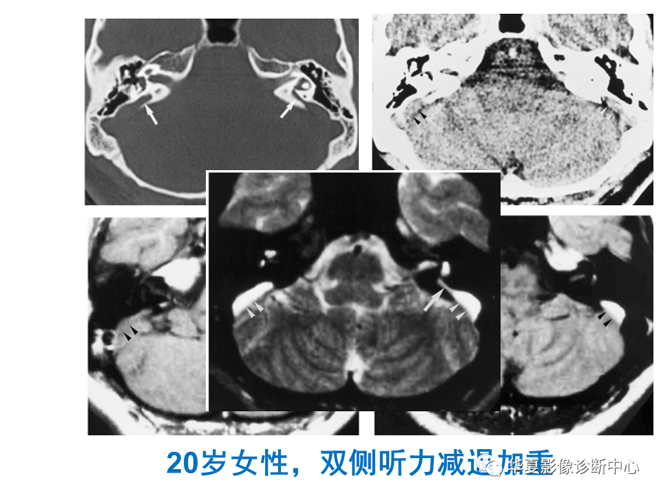 影像PPT - 【PPT】耳的影像解剖及常见疾病诊断-30