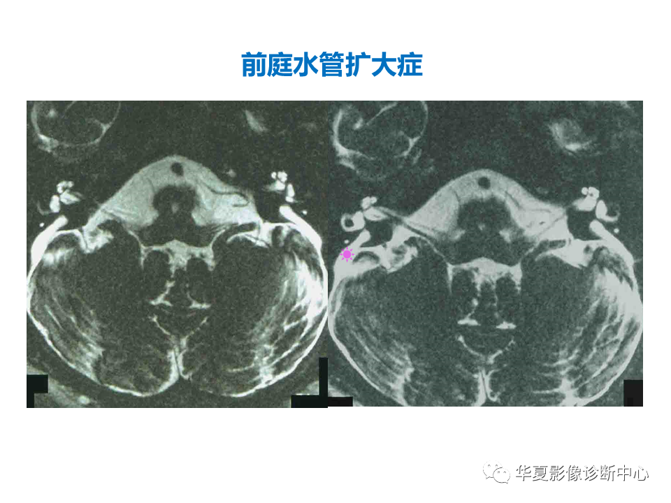 影像PPT - 【PPT】耳的影像解剖及常见疾病诊断-32