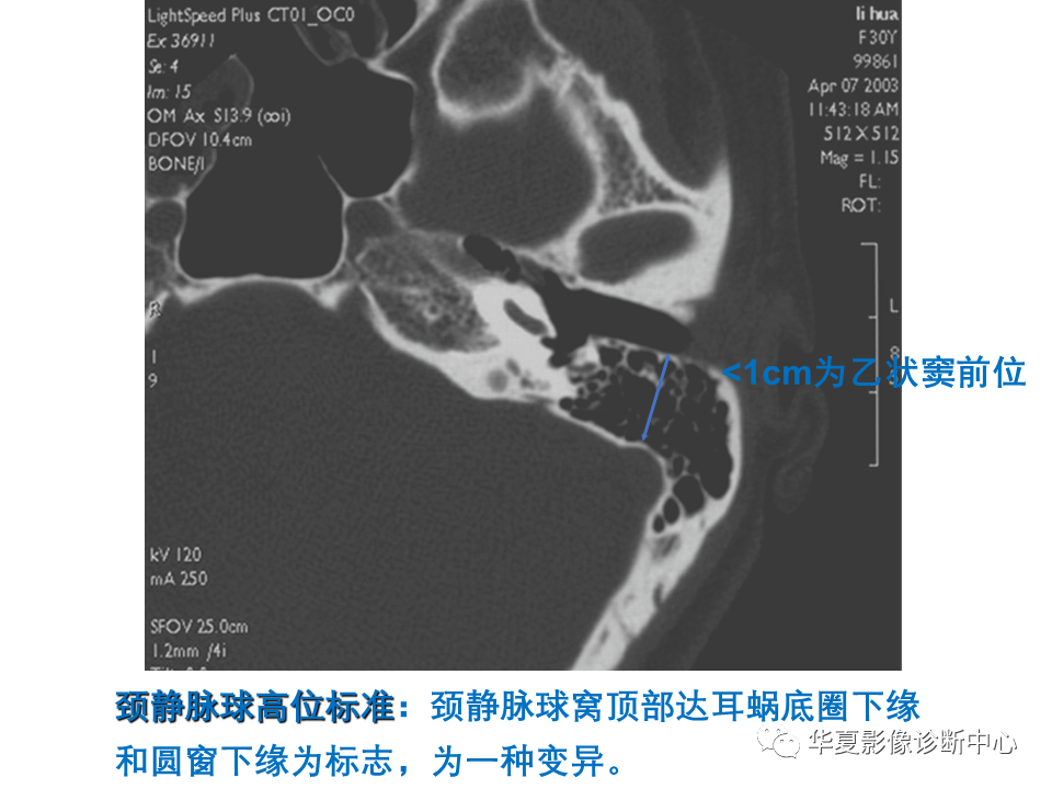 影像PPT - 【PPT】耳的影像解剖及常见疾病诊断-33