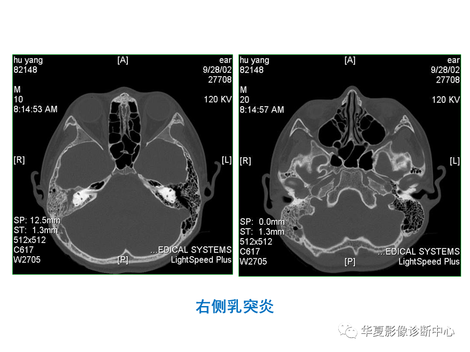 影像PPT - 【PPT】耳的影像解剖及常见疾病诊断-36