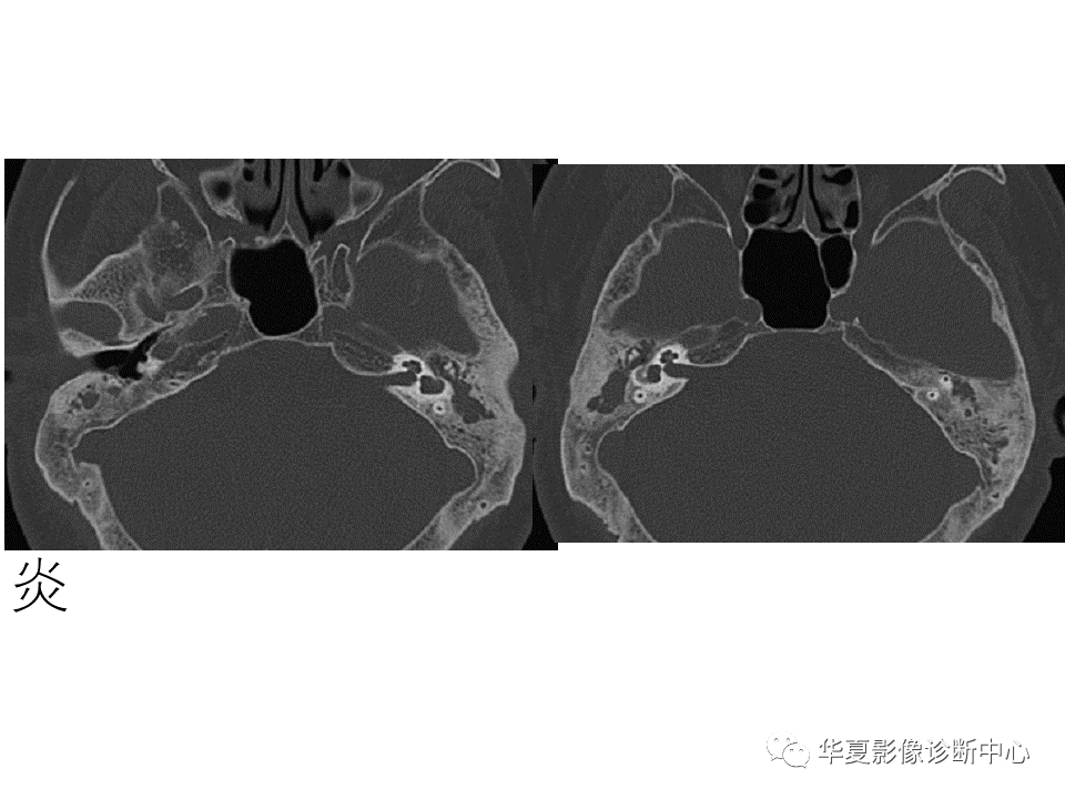 影像PPT - 【PPT】耳的影像解剖及常见疾病诊断-40