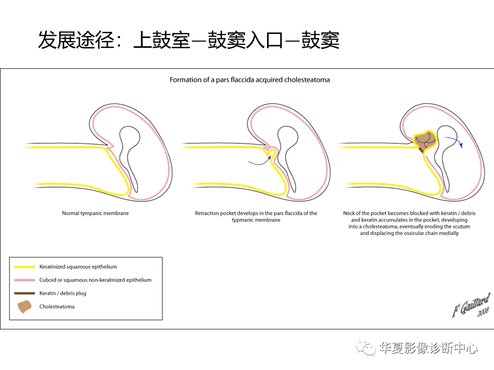 影像PPT - 【PPT】耳的影像解剖及常见疾病诊断-47