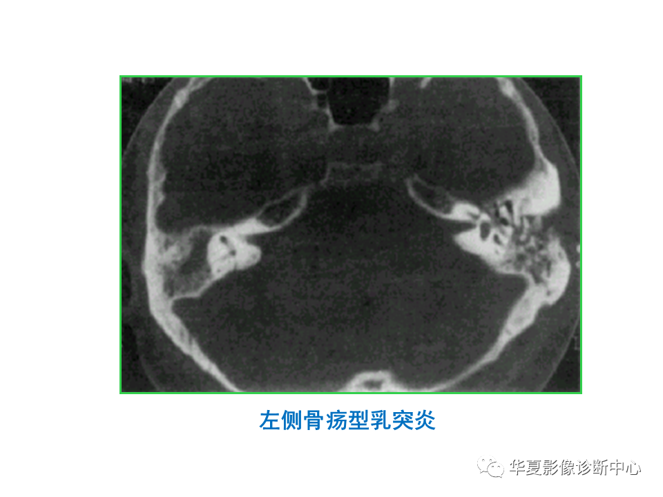 影像PPT - 【PPT】耳的影像解剖及常见疾病诊断-43