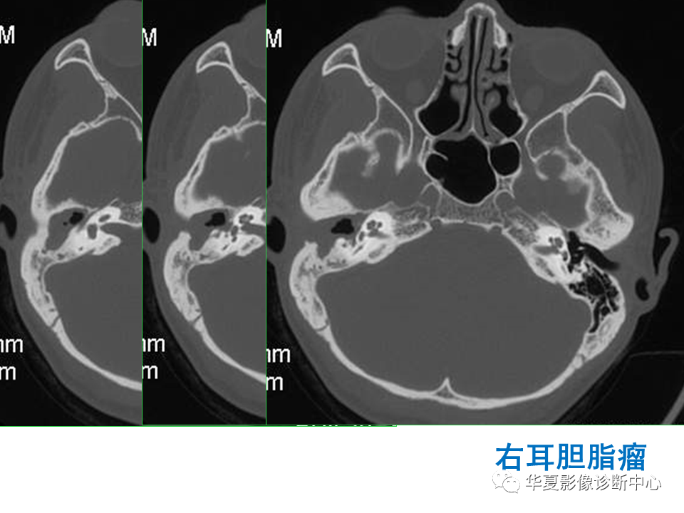 影像PPT - 【PPT】耳的影像解剖及常见疾病诊断-55