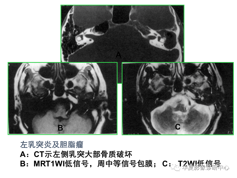 影像PPT - 【PPT】耳的影像解剖及常见疾病诊断-57