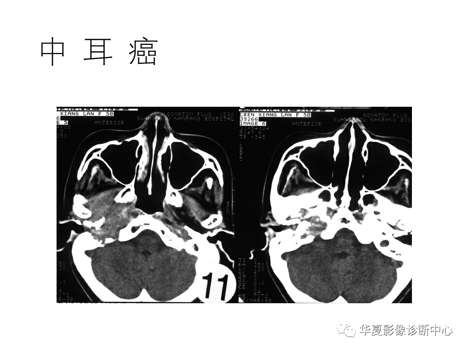 影像PPT - 【PPT】耳的影像解剖及常见疾病诊断-61