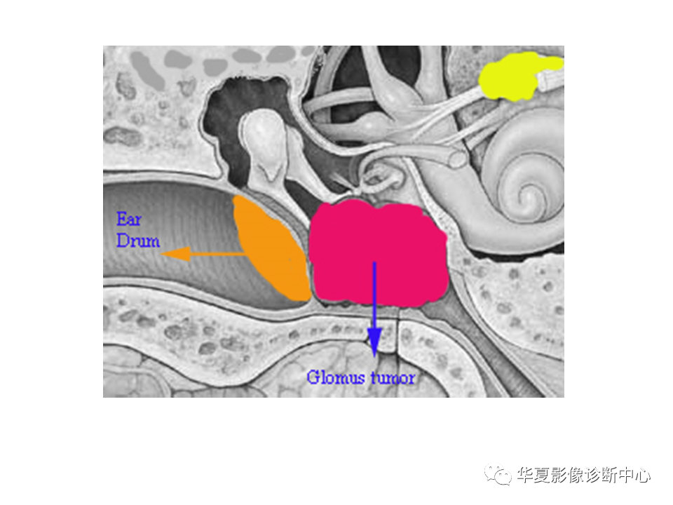 影像PPT - 【PPT】耳的影像解剖及常见疾病诊断-65