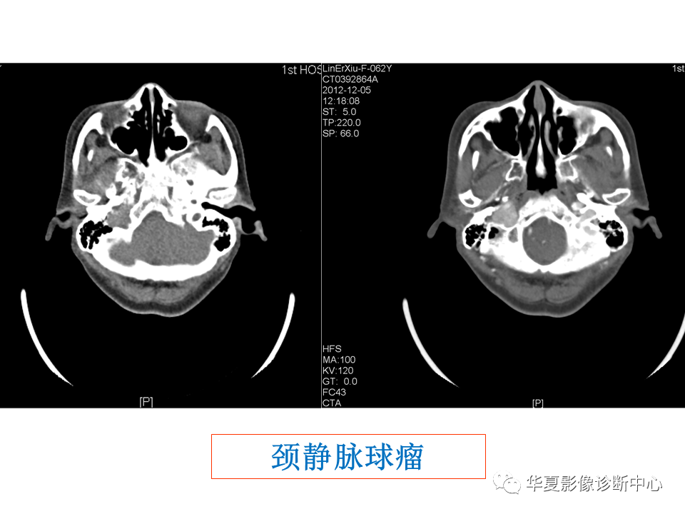 影像PPT - 【PPT】耳的影像解剖及常见疾病诊断-68