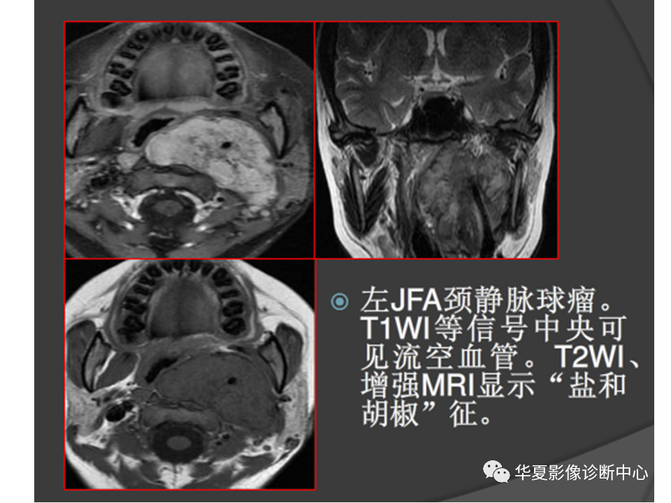 影像PPT - 【PPT】耳的影像解剖及常见疾病诊断-70