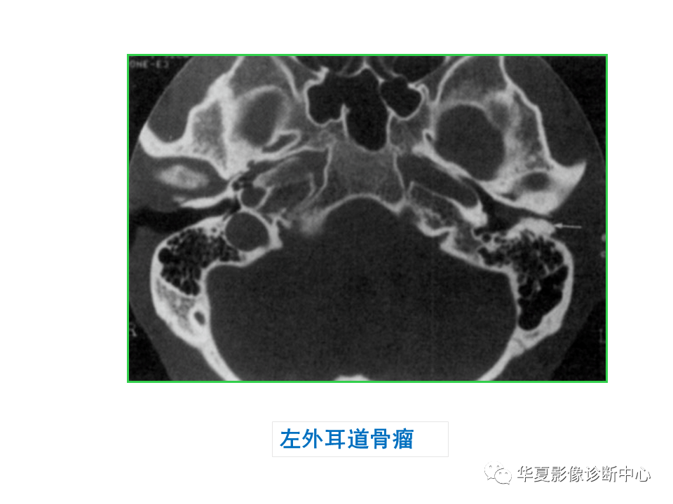 影像PPT - 【PPT】耳的影像解剖及常见疾病诊断-74